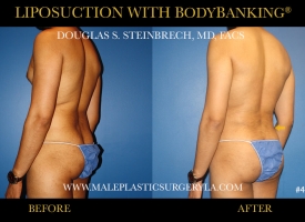 Liposuction - Before & After Photos