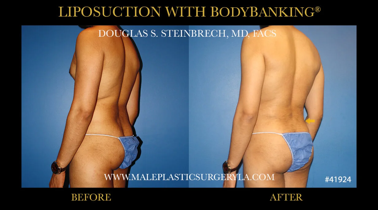 Liposuction - Before & After Photos