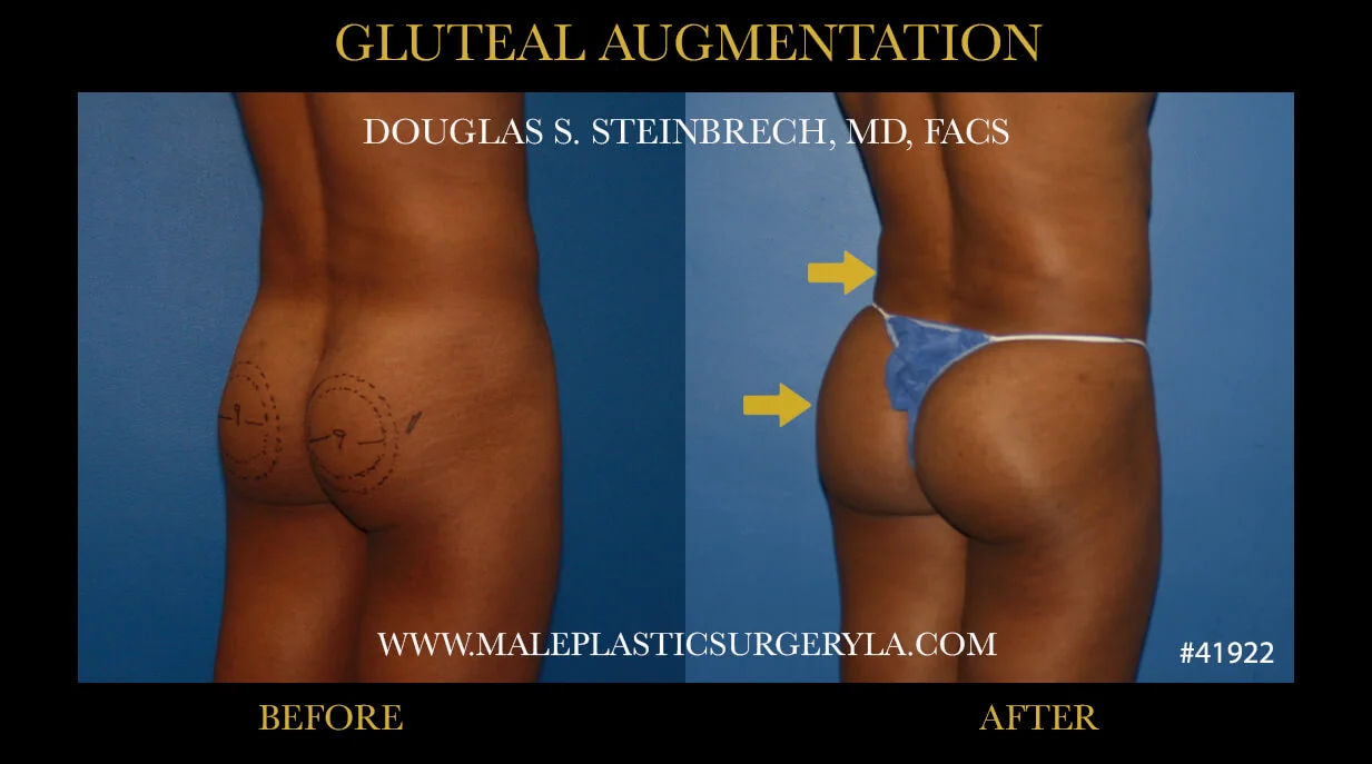 Gluteal Buttock Implants - Before & After Photos