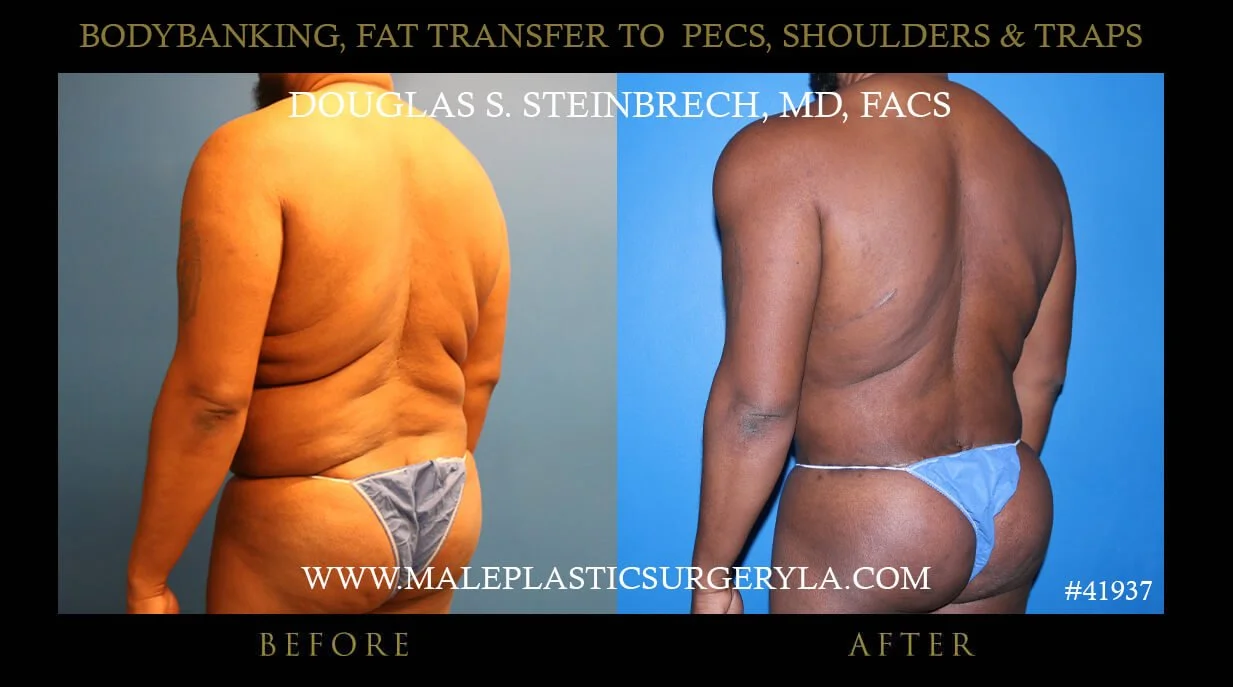 Liposuction - Before & After Photos