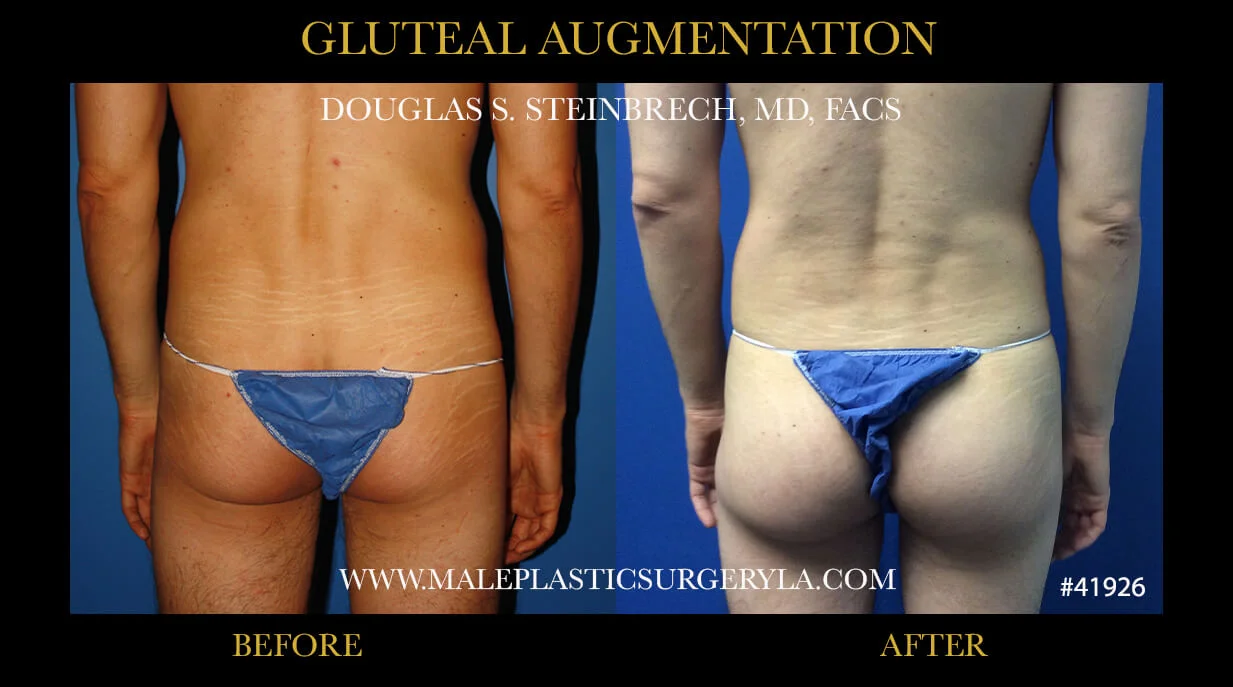 Gluteal Buttock Implants - Before & After Photos