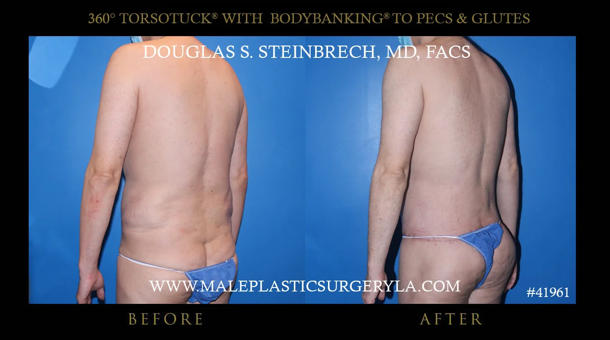 Torsotuck - Before & After Photos