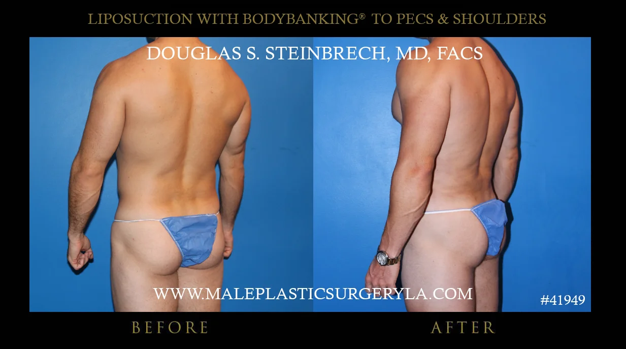 Liposuction - Before & After Photos