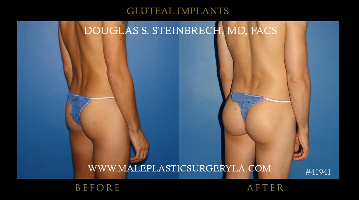 Gluteal Buttock Implants - Before & After Photos