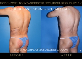 Liposuction - Before & After Photos