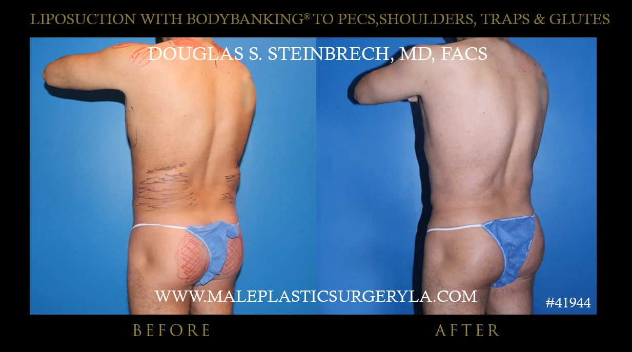 Liposuction - Before & After Photos