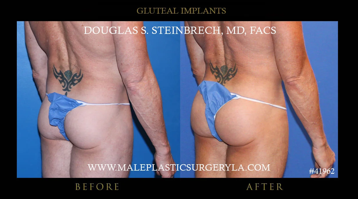 Gluteal Buttock Implants - Before & After Photos