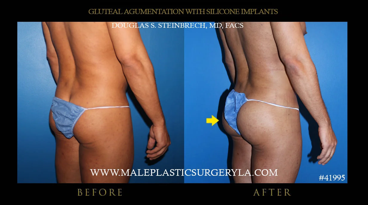 Gluteal Buttock Implants - Before & After Photos