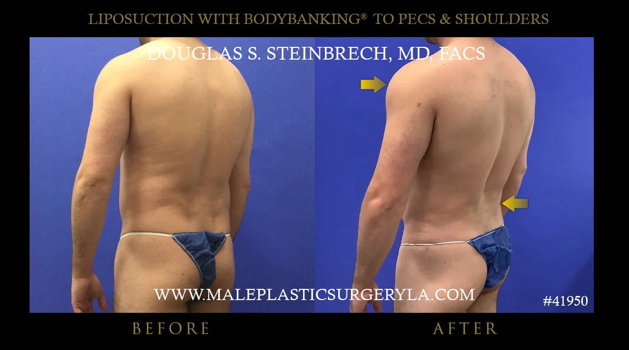 Liposuction - Before & After Photos