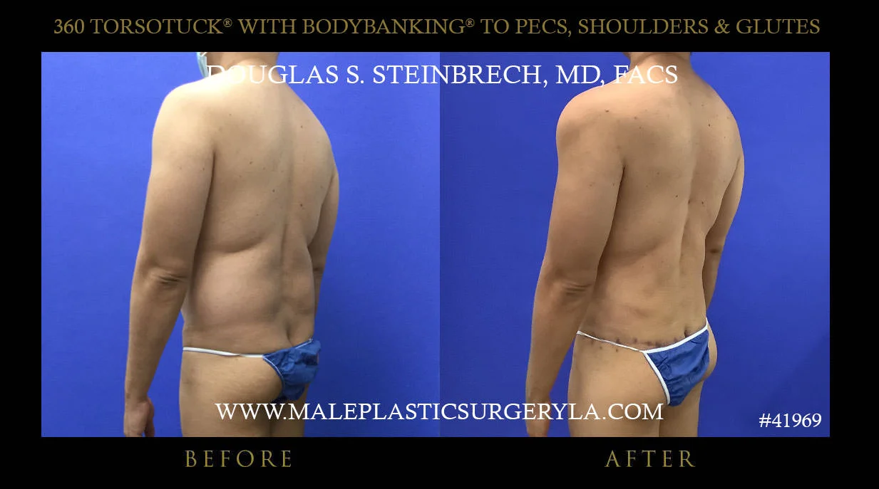 Torsotuck - Before & After Photos