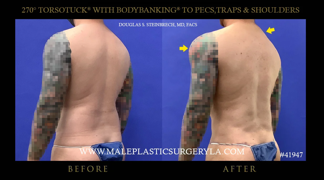 Torsotuck - Before & After Photos