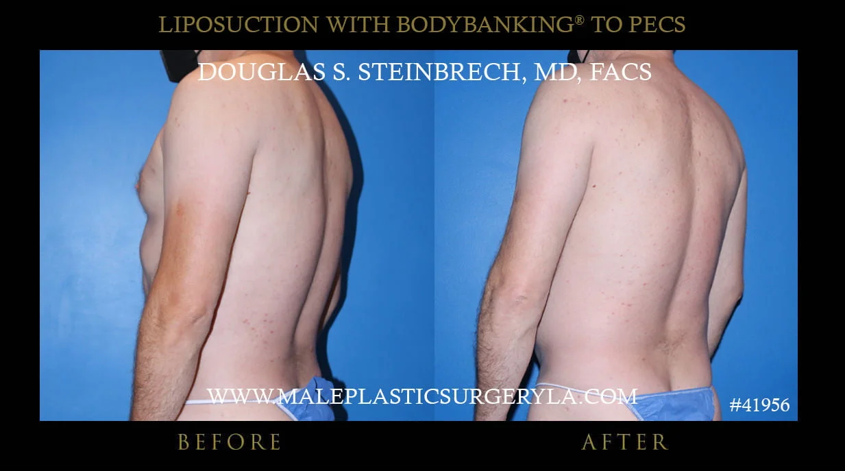 Liposuction - Before & After Photos