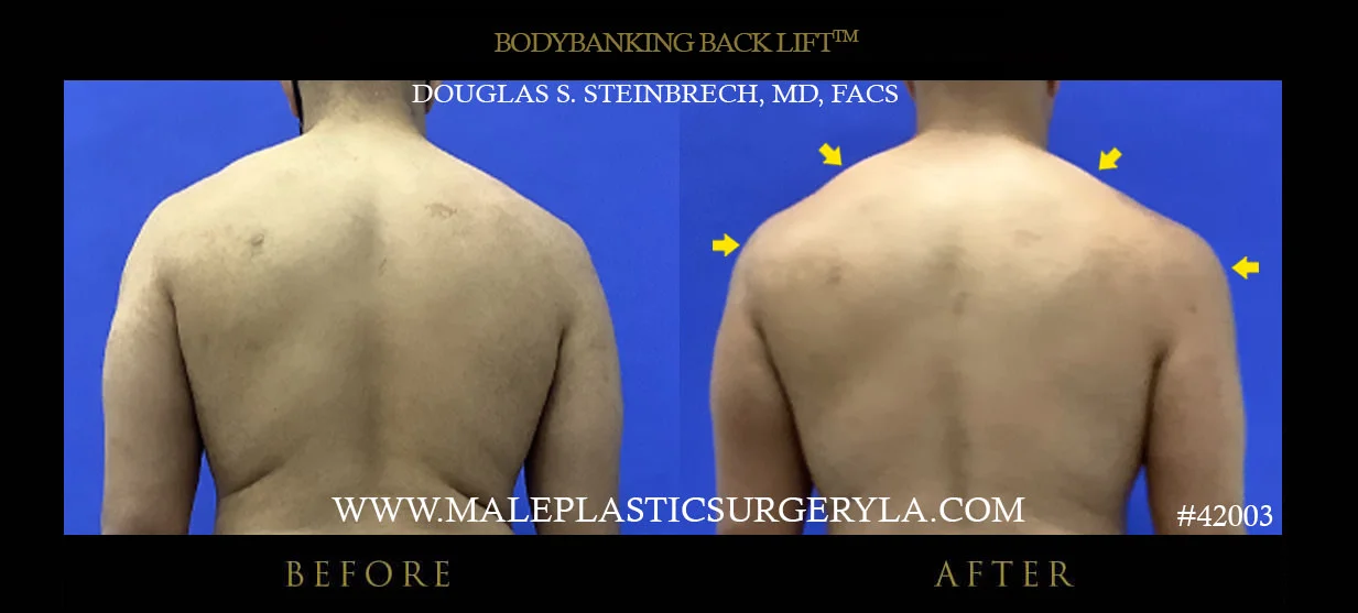 Torsotuck - Before & After Photos