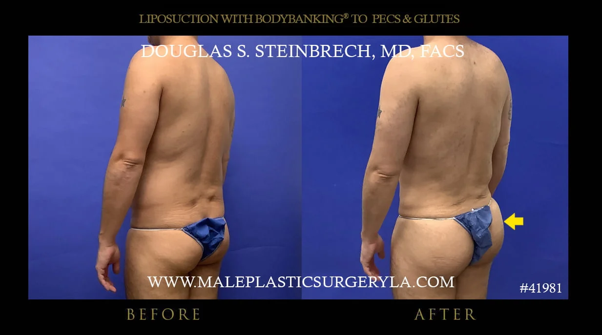 Liposuction - Before & After Photos