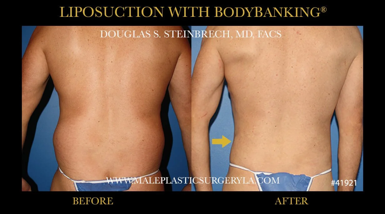 Liposuction - Before & After Photos