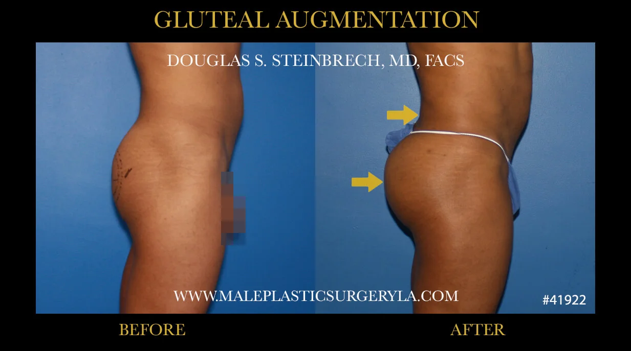 Gluteal Buttock Implants - Before & After Photos