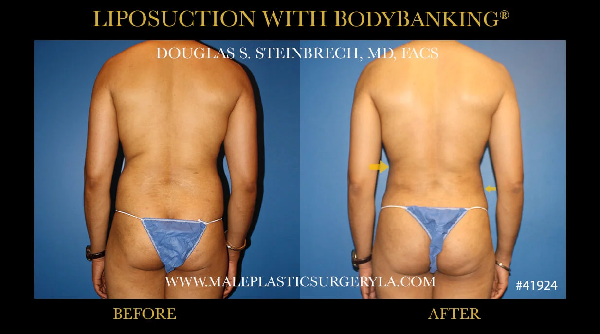 Liposuction - Before & After Photos