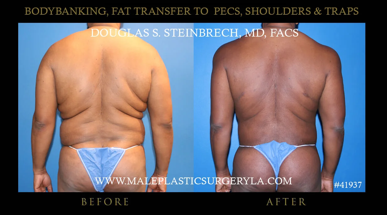 Liposuction - Before & After Photos