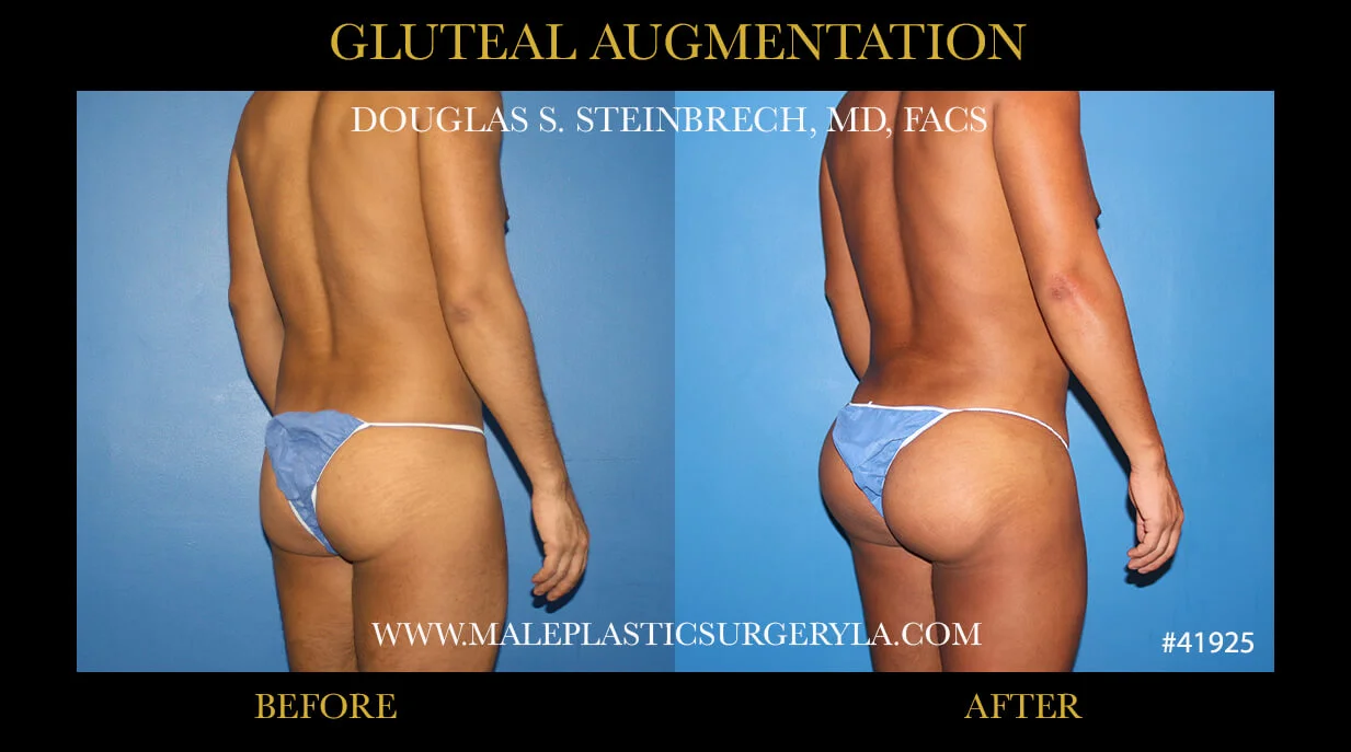 Gluteal Buttock Implants - Before & After Photos