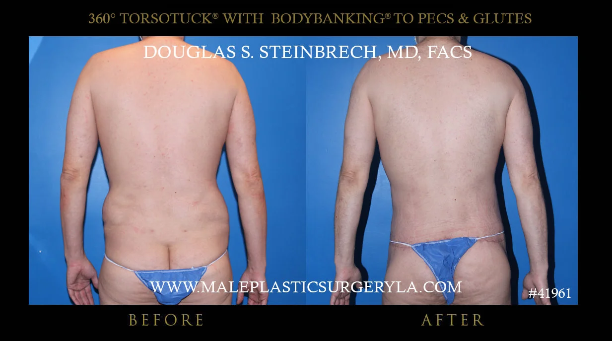 Torsotuck - Before & After Photos