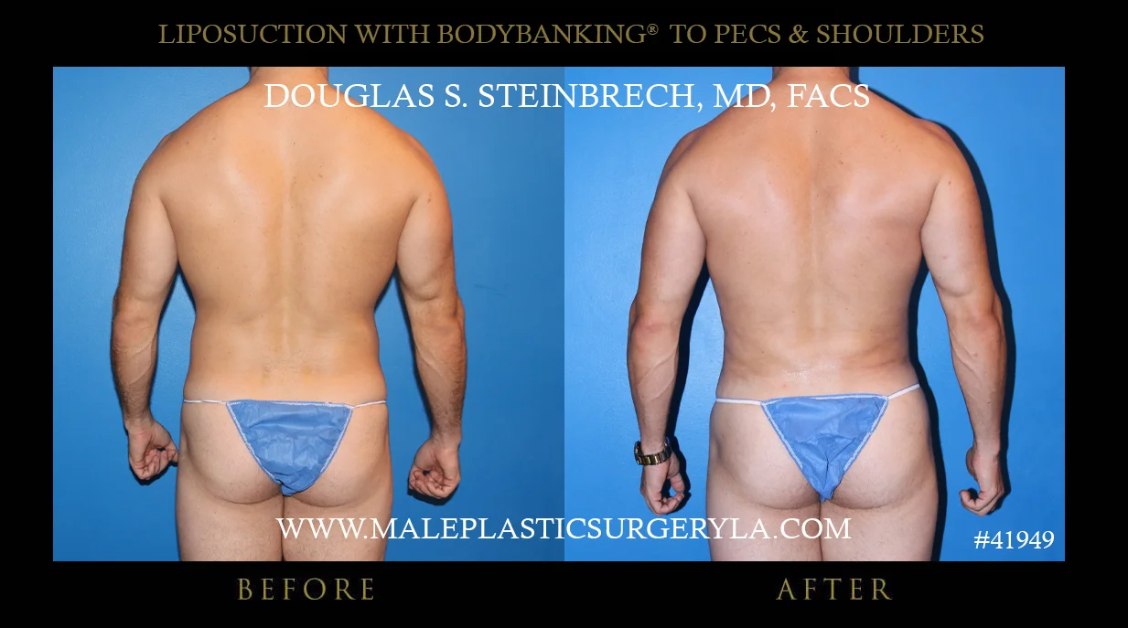 Liposuction - Before & After Photos