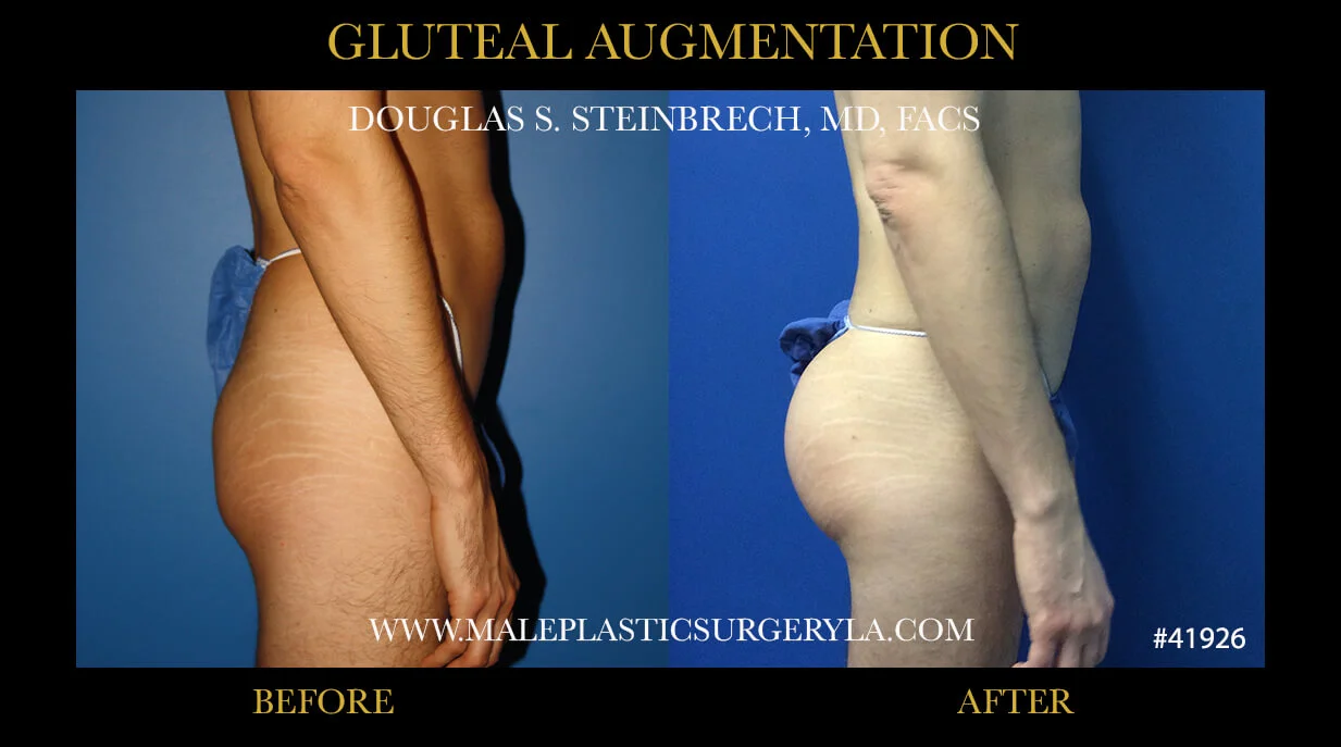 Gluteal Buttock Implants - Before & After Photos