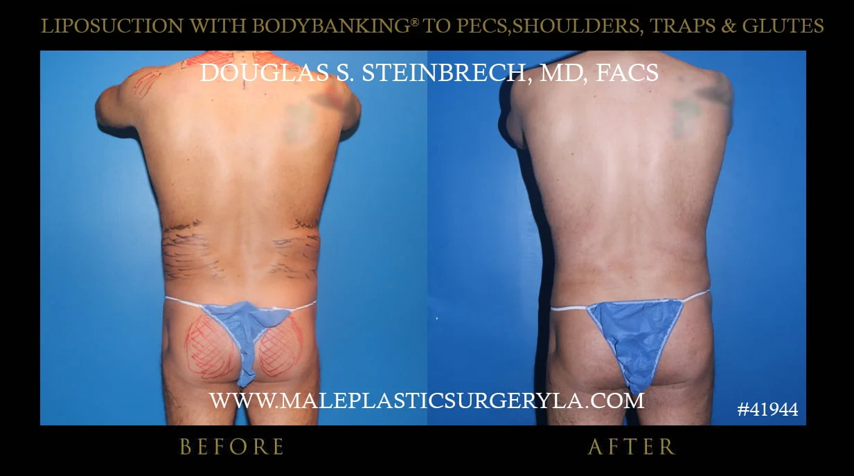 Liposuction - Before & After Photos