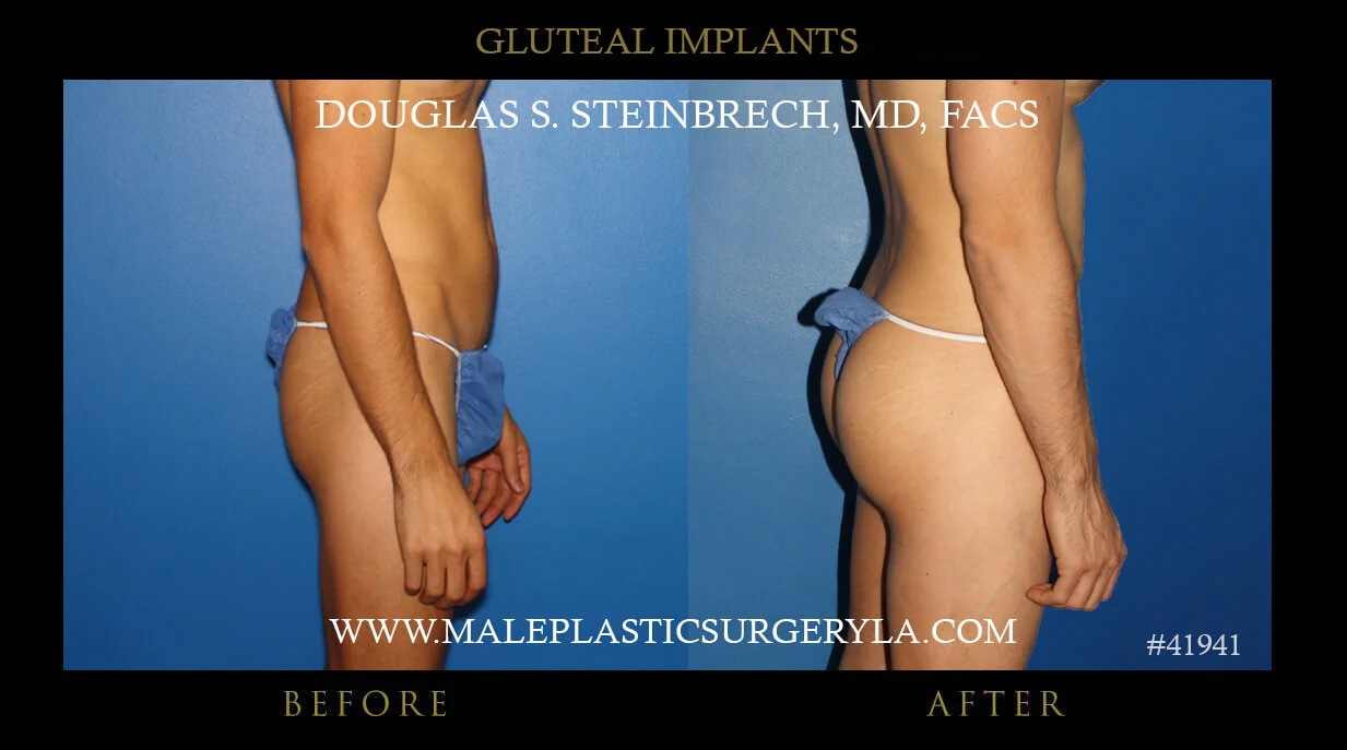 Gluteal Buttock Implants - Before & After Photos