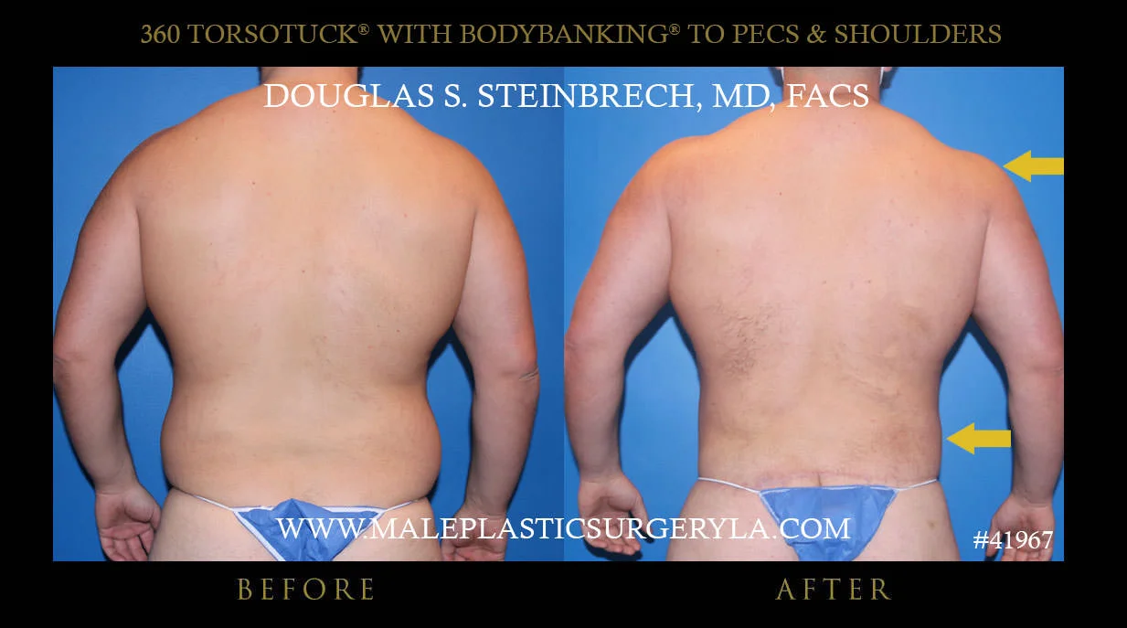 Torsotuck - Before & After Photos