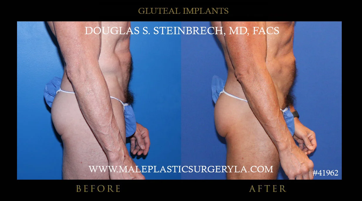 Gluteal Buttock Implants - Before & After Photos