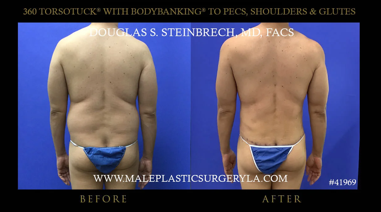 Torsotuck - Before & After Photos