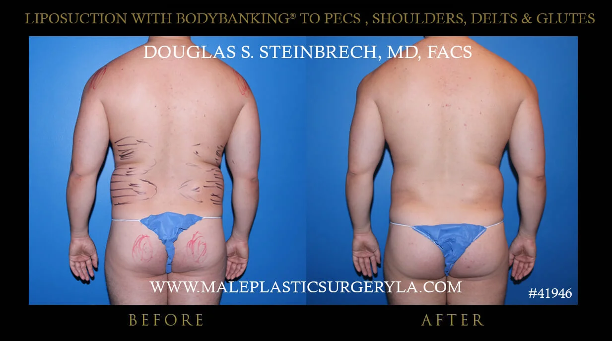 Liposuction - Before & After Photos