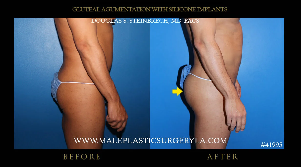 Gluteal Buttock Implants - Before & After Photos