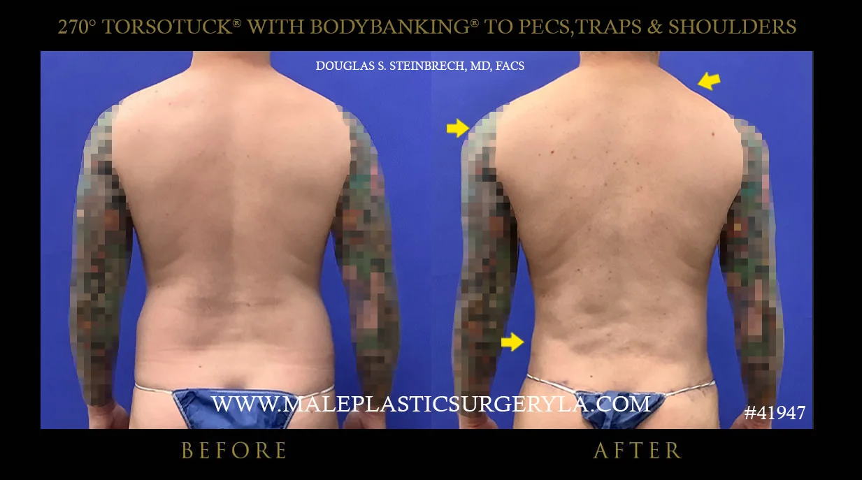 Torsotuck - Before & After Photos