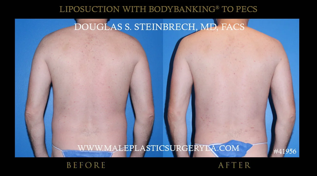 Liposuction - Before & After Photos