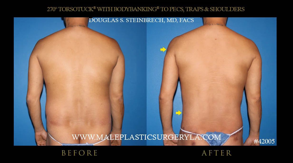 Torsotuck - Before & After Photos