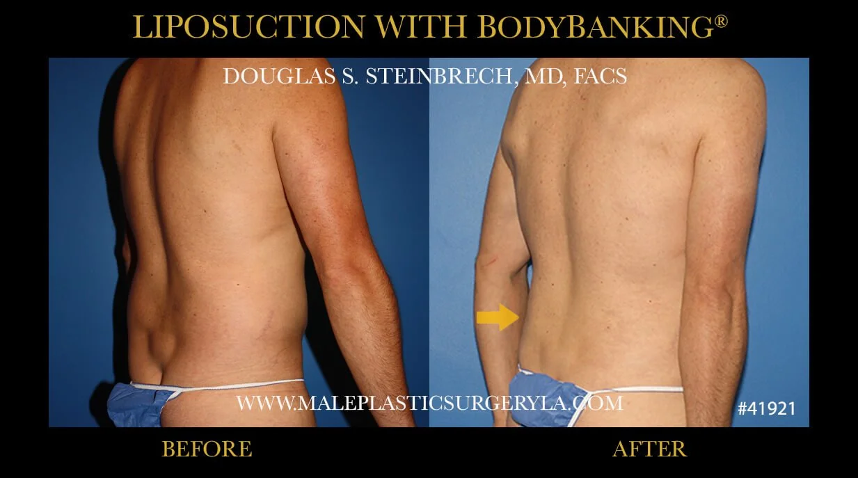 Liposuction - Before & After Photos