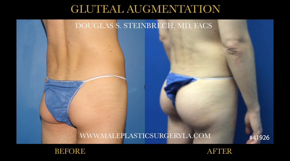 Gluteal Buttock Implants - Before & After Photos