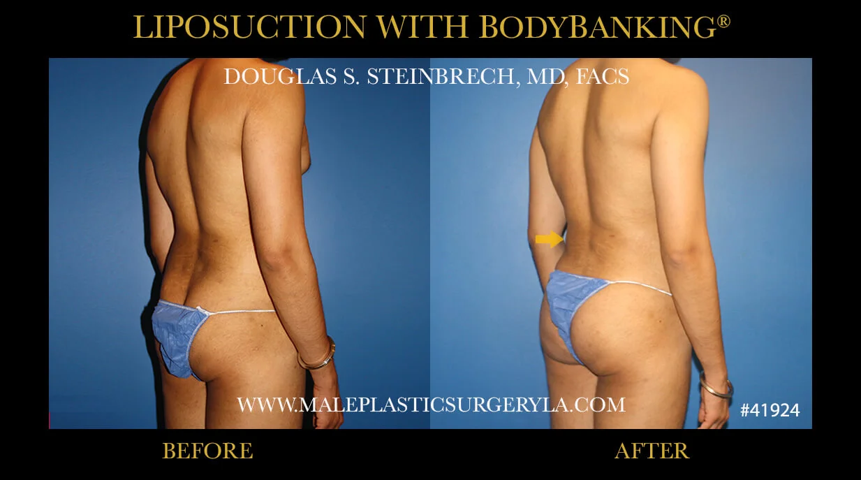 Liposuction - Before & After Photos