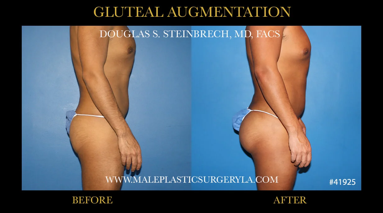 Gluteal Buttock Implants - Before & After Photos