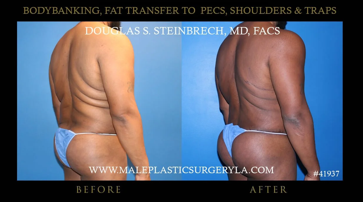 Liposuction - Before & After Photos