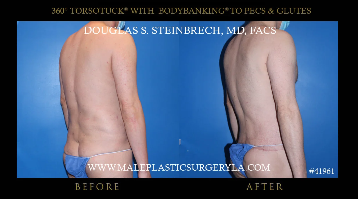 Torsotuck - Before & After Photos