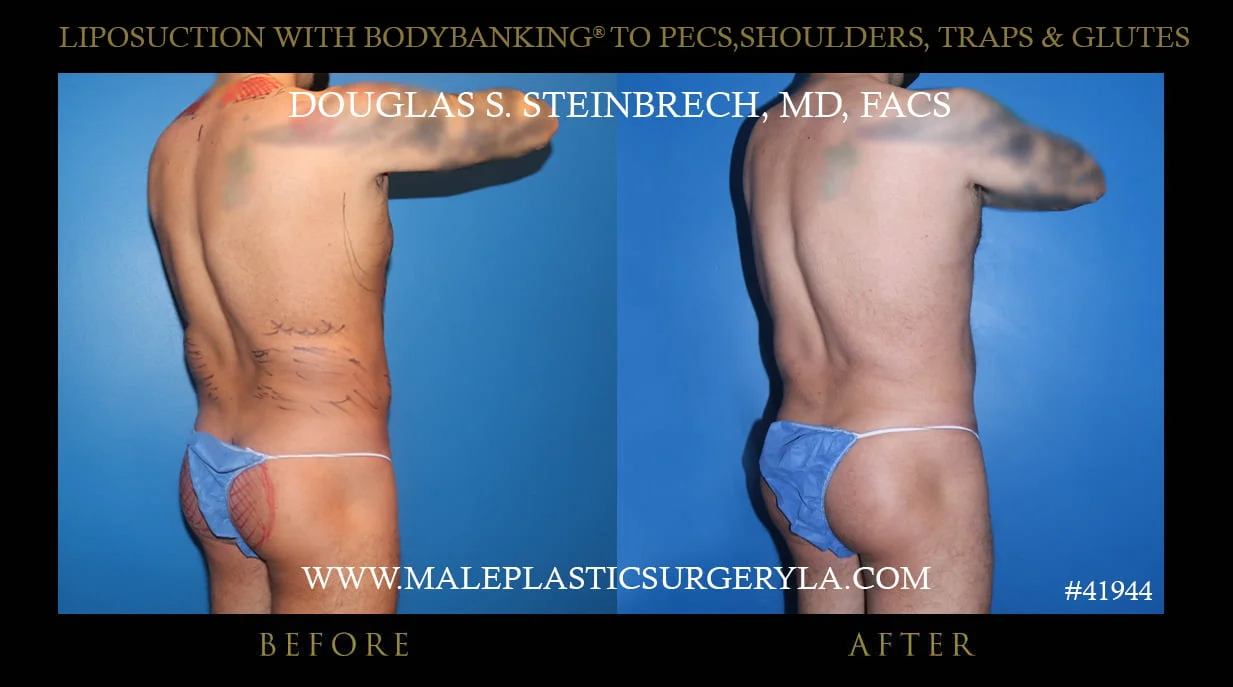 Liposuction - Before & After Photos