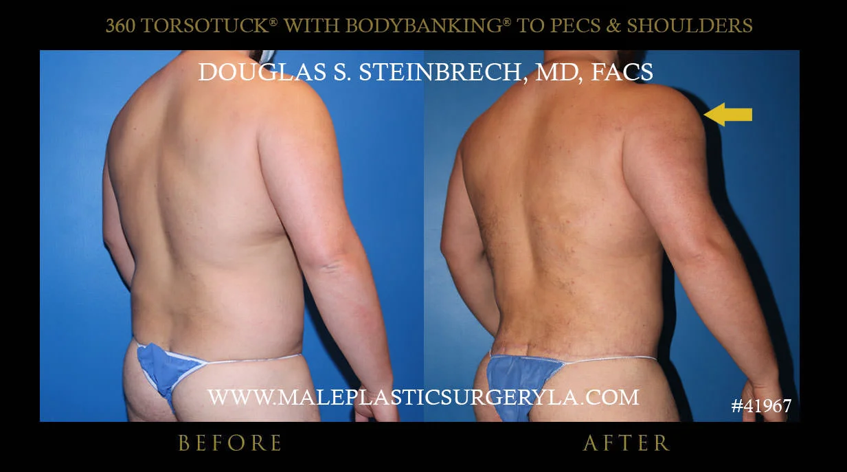 Torsotuck - Before & After Photos