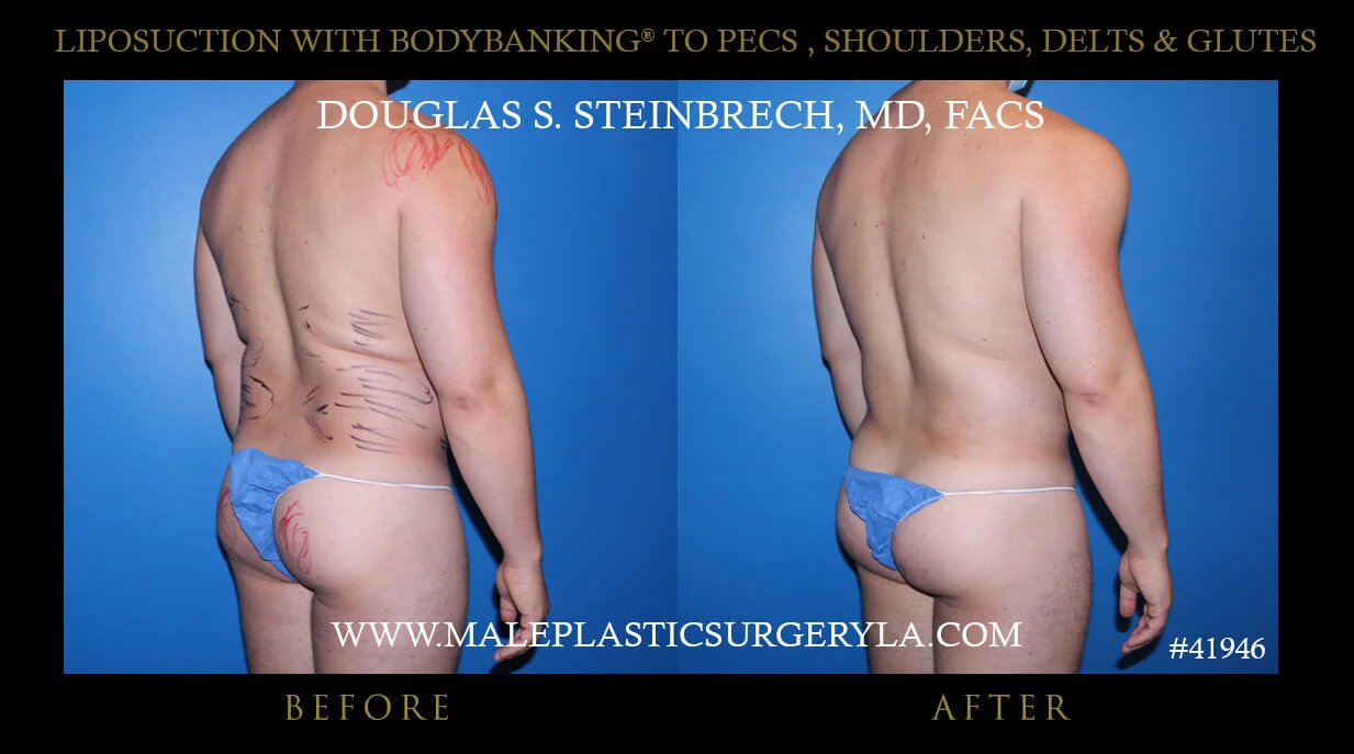 Liposuction - Before & After Photos