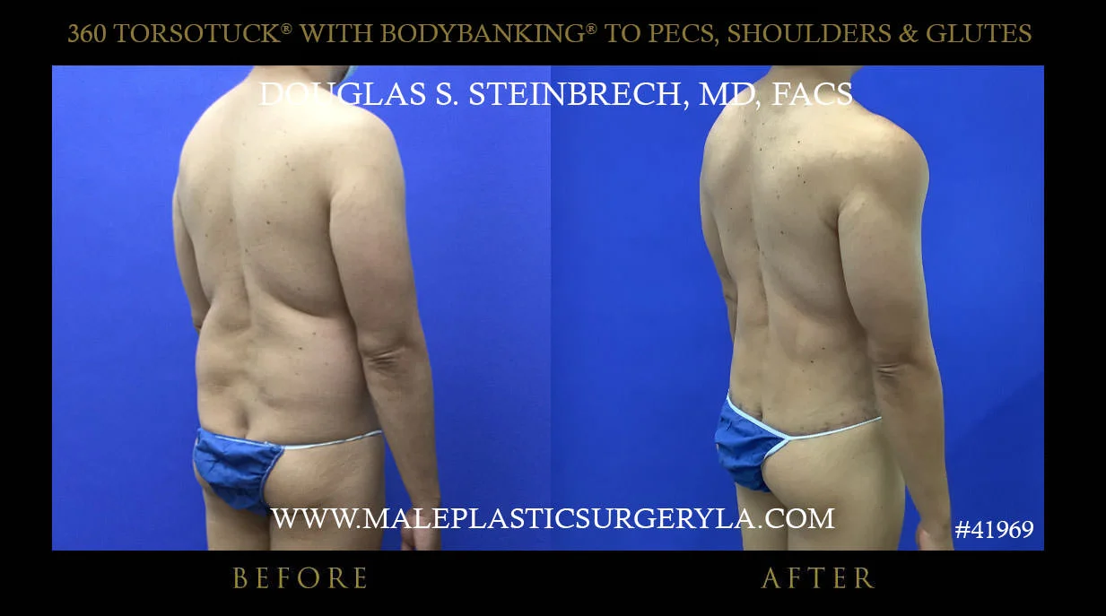 Torsotuck - Before & After Photos