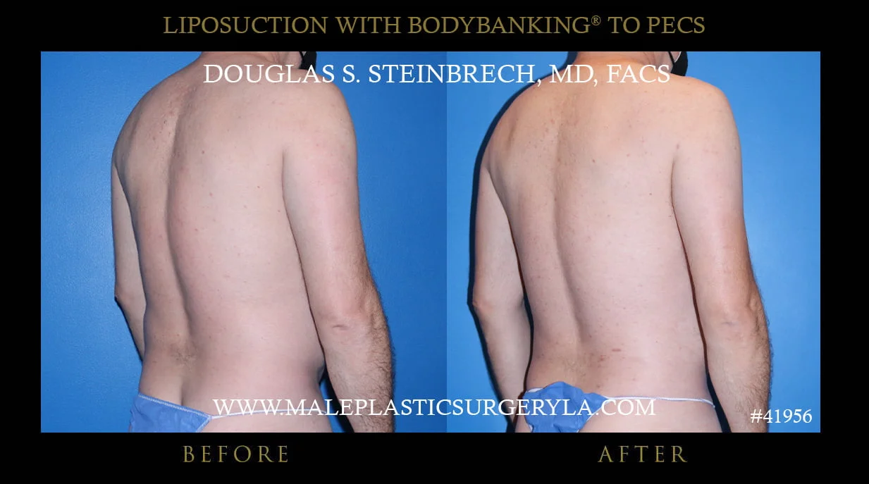 Liposuction - Before & After Photos