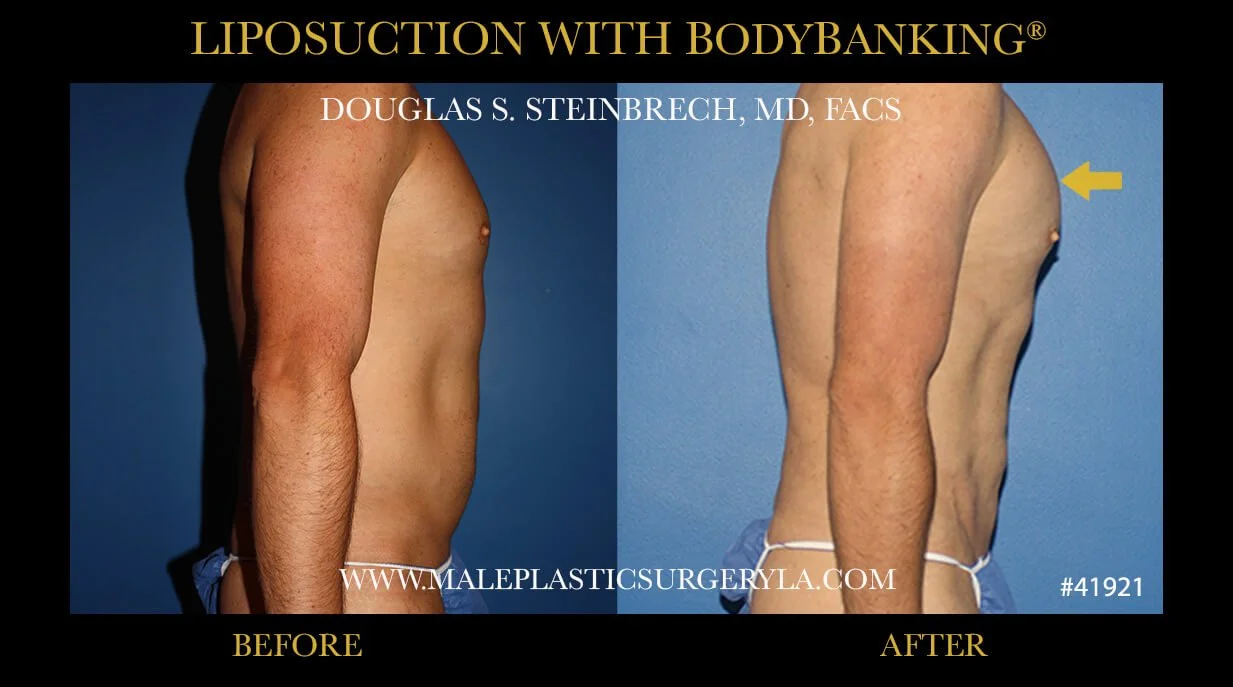 Liposuction - Before & After Photos