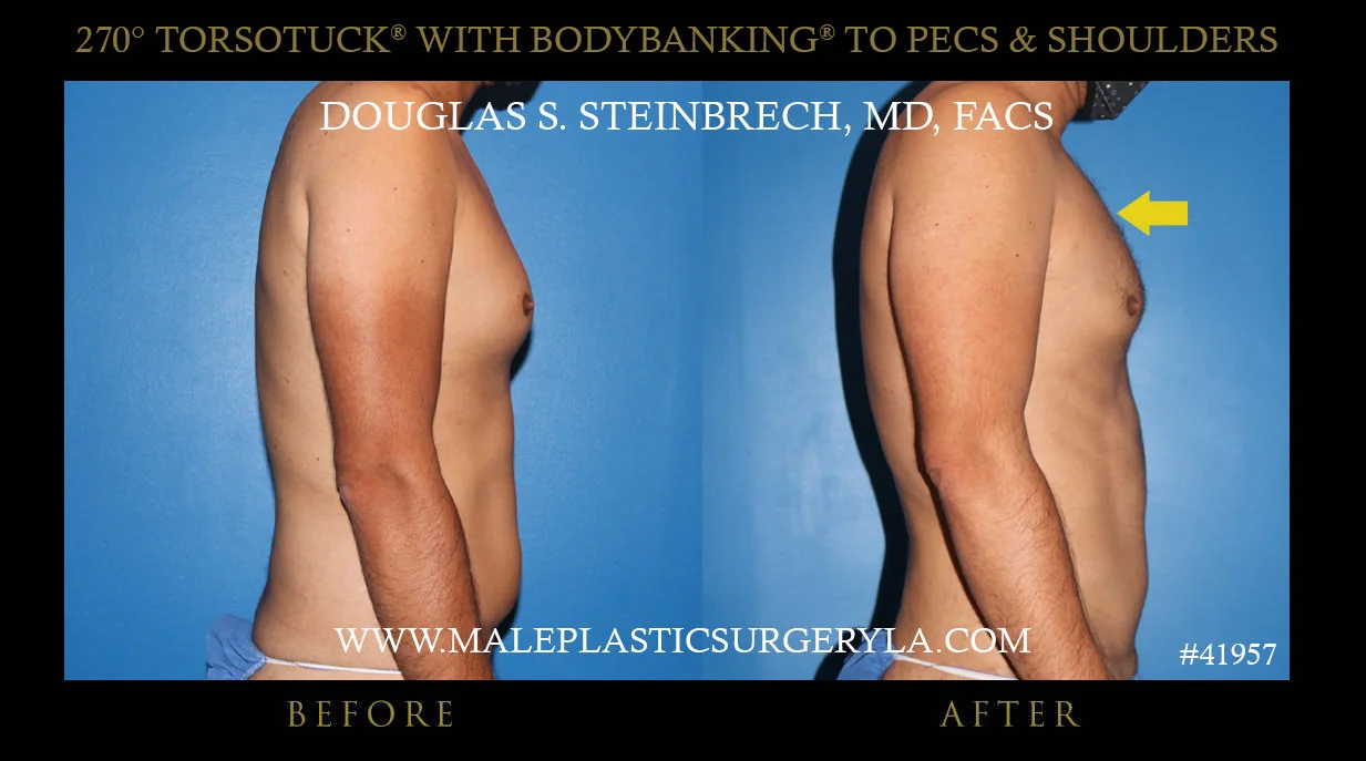 Torsotuck - Before & After Photos