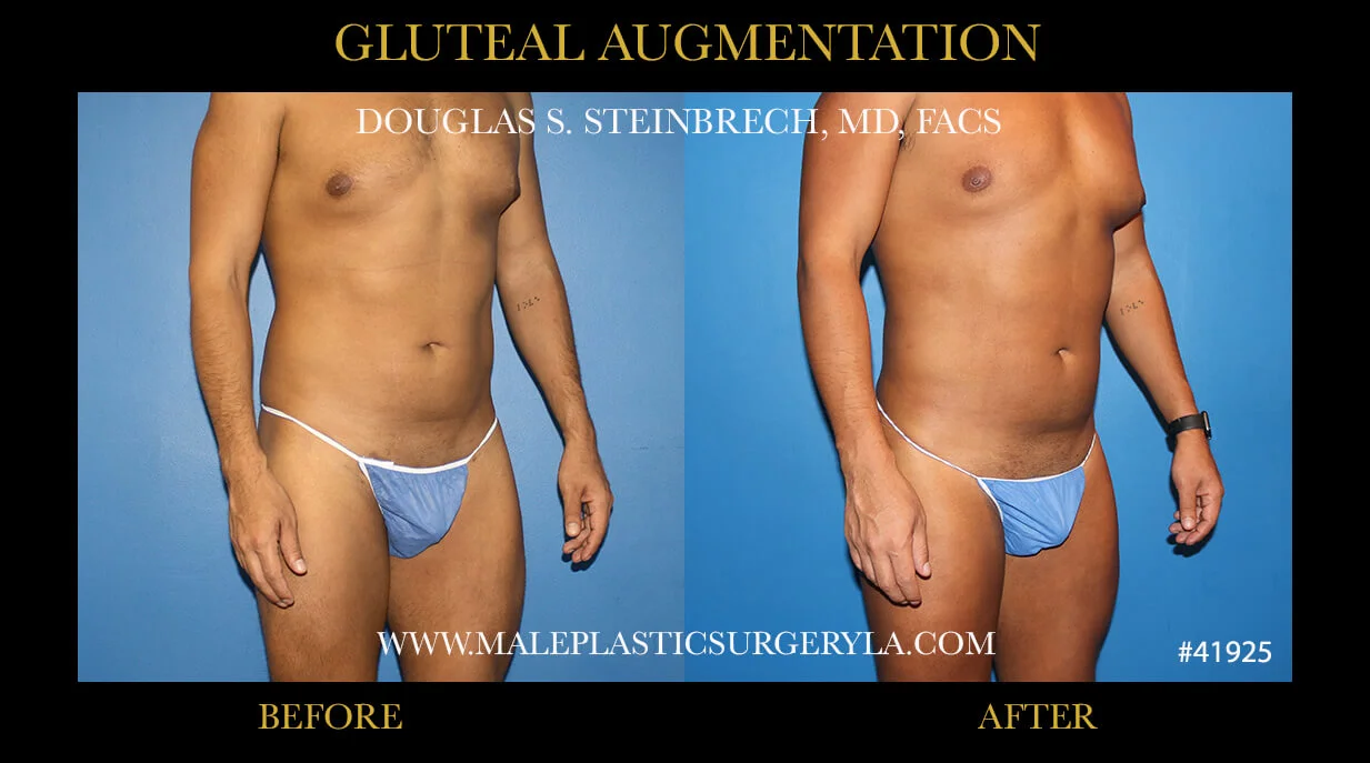 Gluteal Buttock Implants - Before & After Photos